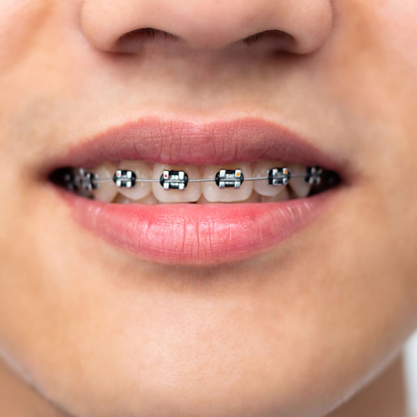 braces on teeth