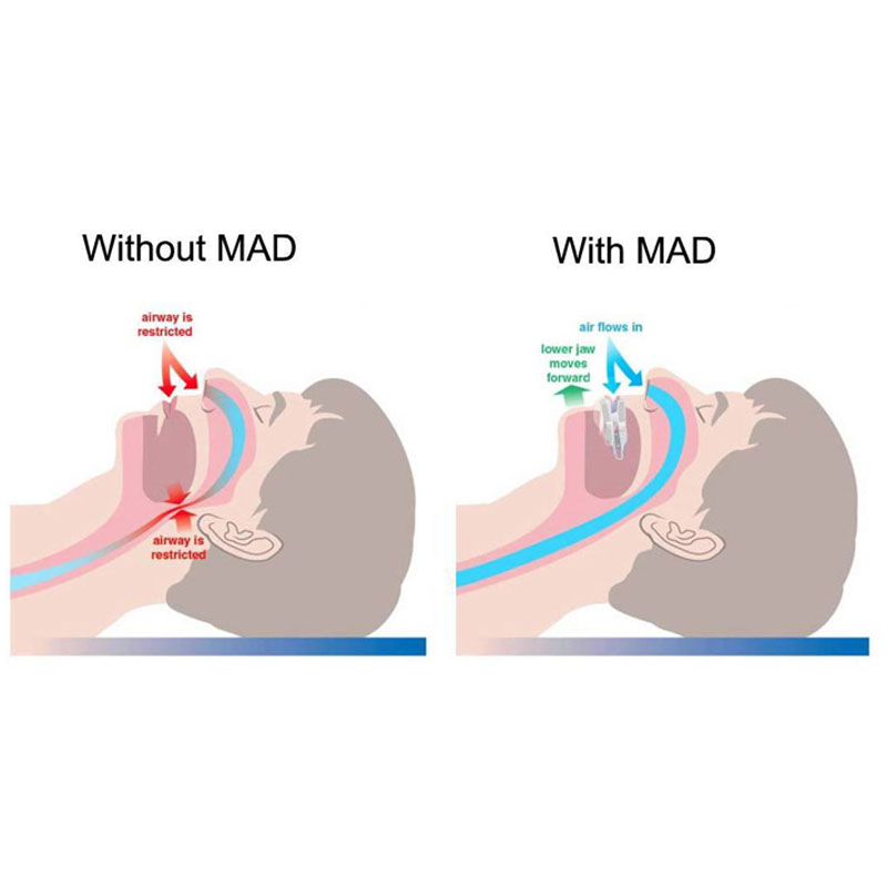 Sleep Apnea Treatment in Aldershot, Burlington